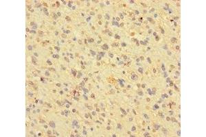 Immunohistochemistry of paraffin-embedded human glioma using ABIN7163790 at dilution of 1:100