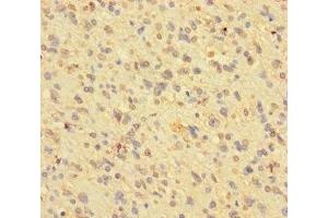 Immunohistochemistry of paraffin-embedded human glioma using ABIN7163790 at dilution of 1:100 (BMI1 anticorps  (AA 1-247))