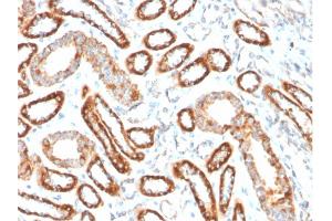 Formalin-fixed, paraffin-embedded human Renal Cell Carcinoma stained with CD137-Monospecific Mouse Monoclonal Antibody (4-1BB/3201).
