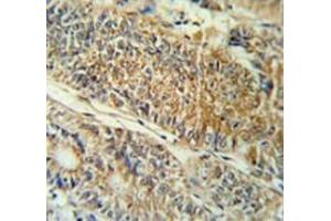 Immunohistochemistry analysis in colon carcinoma (Formalin-fixed, Paraffin-embedded) using PYCR1  Antibody (C-term), followed by peroxidase conjugation of the secondary antibody and DAB staining. (PYCR1 anticorps  (C-Term))
