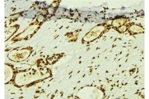ABIN6274367 at 1/100 staining Human breast cancer tissue by IHC-P. (TAF5 anticorps  (Internal Region))