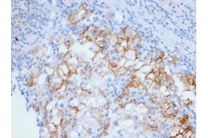Formalin-fixed, paraffin-embedded human Renal Cell Carcinoma stained with Cadherin 16 Mouse Monoclonal Antibody (CDH16/2448). (Cadherin-16 anticorps  (AA 371-507))