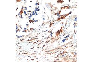 Immunohistochemistry of paraffin-embedded human lung cancer using JNK1/2/3 Rabbit pAb (ABIN7268630) at dilution of 1:100 (40x lens). (MAPK8/9/10 anticorps)