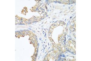 Immunohistochemistry of paraffin-embedded human prostate using CBL antibody (ABIN6131302, ABIN6138002, ABIN6138004 and ABIN6213970) at dilution of 1:200 (40x lens). (CBL anticorps  (AA 637-906))