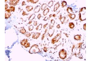 Formalin-fixed, paraffin-embedded human Breast Carcinoma stained with ERCC1 Mouse Monoclonal Antibody (ERCC1/2318). (ERCC1 anticorps  (AA 191-281))