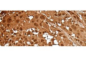 Immunohistochemistry of paraffin-embedded Human esophagus cancer tissue using LAMTOR5 Polyclonal Antibody at dilution of 1:35(x200) (HBXIP anticorps)