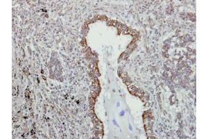 IHC-P Image Immunohistochemical analysis of paraffin-embedded human lung adenocarcinoma, using VAPA, antibody at 1:500 dilution.