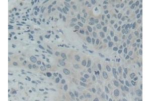 Detection of SNAP25 in Human Lung cancer Tissue using Polyclonal Antibody to Synaptosomal Associated Protein 25 kDa (SNAP25) (SNAP25 anticorps  (AA 1-206))