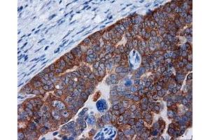 Immunohistochemical staining of paraffin-embedded Adenocarcinoma of breast tissue using anti-RALBP1 mouse monoclonal antibody.