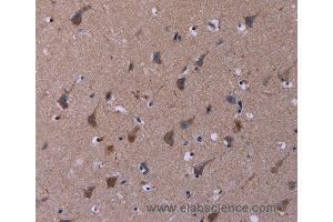 Immunohistochemistry of Human thyroid cancer using TUBGCP2 Polyclonal Antibody at dilution of 1:50 (TUBGCP2 anticorps)