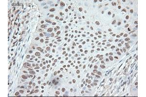 Immunohistochemical staining of paraffin-embedded Adenocarcinoma of colon using anti-Nog (ABIN2452676) mouse monoclonal antibody. (NOG anticorps  (AA 28-232))