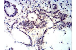 Immunohistochemical analysis of paraffin-embedded colon cancer tissues using BCL11B mouse mAb with DAB staining.