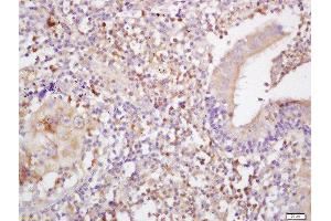 Formalin-fixed and paraffin embedded human lung carcinoma labeled with Anti-MHC Class I Polyclonal Antibody, Unconjugated (ABIN1713559) at 1:200 followed by conjugation to the secondary antibody and DAB staining (MHC, Class I anticorps  (AA 81-180))
