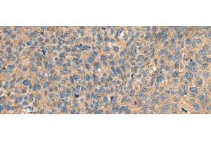 Immunohistochemistry of paraffin-embedded Human cervical cancer tissue using AHNAK Polyclonal Antibody at dilution of 1:50(x200) (AHNAK anticorps)