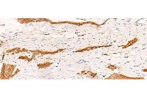 Immunohistochemistry of paraffin-embedded Human esophagus cancer tissue using THNSL1 Polyclonal Antibody at dilution of 1:70(x200) (THNSL1 anticorps)