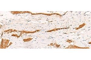 Immunohistochemistry of paraffin-embedded Human esophagus cancer tissue using THNSL1 Polyclonal Antibody at dilution of 1:70(x200) (THNSL1 anticorps)