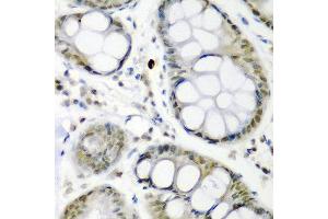 Immunohistochemistry of paraffin-embedded human colon carcinoma using CDC27 antibody at dilution of 1:200 (40x lens). (CDC27 anticorps)