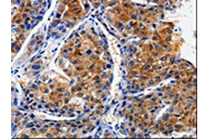 The image on the left is immunohistochemistry of paraffin-embedded Human liver cancer tissue using ABIN7128952(CLCA4 Antibody) at dilution 1/10, on the right is treated with fusion protein. (CLCA4 anticorps)