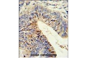 Formalin-fixed and paraffin-embedded human colon carcinoma reacted with ADDEC1 Antibody (N-term), which was peroxidase-conjugated to the secondary antibody, followed by DAB staining.