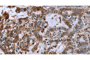Immunohistochemistry of paraffin-embedded Human liver cancer using IMPDH2 Polyclonal Antibody at dilution of 1:60 (IMPDH2 anticorps)
