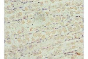Immunohistochemistry of paraffin-embedded human gastric cancer using ABIN7176235 at dilution of 1:100 (ZNF324 anticorps  (AA 1-270))