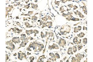 ABIN6261558 and ABIN6268802 at 1/100 staining Human pancreatic cancer by IHC-P. (EPH Receptor A3 anticorps  (C-Term))