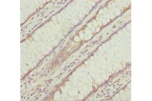 Immunohistochemistry of paraffin-embedded human colon cancer using ABIN7157310 at dilution of 1:100 (KLHL7 anticorps  (AA 427-586))