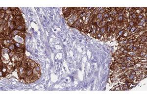 ABIN6276569 at 1/100 staining Human urothelial cancer tissue by IHC-P. (SMPD2 anticorps  (Internal Region))