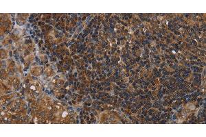 Immunohistochemistry of paraffin-embedded Human thyroid cancer tissue using HOMER2 Polyclonal Antibody at dilution 1:40 (HOMER2 anticorps)