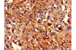 IHC image of ABIN7155391 diluted at 1:800 and staining in paraffin-embedded human melanoma performed on a Leica BondTM system.