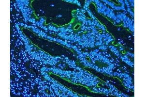 IF analysis of Villi using anti-Villi antibody (ABIN3042343) Villi was detected in paraffin-embedded section of human rectal cancer tissues. (Villin 1 anticorps  (C-Term))