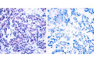 P-Peptide - +Immunohistochemical analysis of paraffin-embedded human breast carcinoma tissue using JunD (phospho- Ser255) antibody. (JunD anticorps  (pSer255))