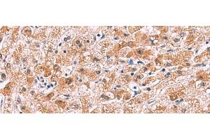 Immunohistochemistry of paraffin-embedded Human liver cancer tissue using IL4R Polyclonal Antibody at dilution of 1:45(x200) (IL4 Receptor anticorps)