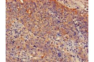 Immunohistochemistry of paraffin-embedded human cervical cancer using ABIN7148581 at dilution of 1:100 (SPRR1A anticorps  (AA 8-72))