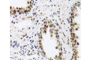 Immunohistochemistry of paraffin-embedded Human prostate using SAFB2 Polyclonal Antibody at dilution of 1:100 (40x lens). (SAFB2 anticorps)
