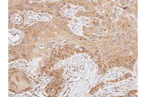 IHC-P Image Immunohistochemical analysis of paraffin-embedded SCC15 xenograft, using FAST, antibody at 1:100 dilution. (FASTK anticorps  (C-Term))