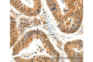 Immunohistochemistry of Human colon cancer using TERF2 Polyclonal Antibody at dilution of 1:50 (TRF2 anticorps)