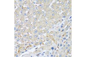 Immunohistochemistry of paraffin-embedded human liver cancer using PPBP antibody (ABIN5970990) at dilution of 1/100 (40x lens). (CXCL7 anticorps)