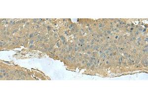 Immunohistochemistry of paraffin-embedded Human liver cancer tissue using KRT36 Polyclonal Antibody at dilution of 1:50(x200) (Keratin 36 anticorps)