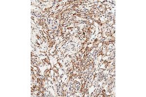 Immunohistochemical analysis of paraffin-embedded Human breast carcinoma tissue using B performed on the Leica® BOND RXm. (FGFR2 anticorps  (C-Term))
