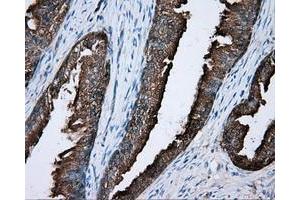 Immunohistochemical staining of paraffin-embedded Carcinoma of liver tissue using anti-PRKAR2A mouse monoclonal antibody.