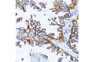 Immunohistochemistry of paraffin-embedded human lung cancer using Cytokeratin 7 (Cytokeratin 7 (KRT7)) antibody (ABIN6129292, ABIN6143037, ABIN6143039 and ABIN6215559) at dilution of 1:200 (40x lens).