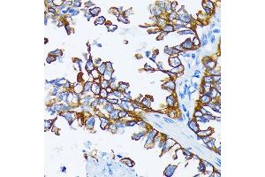 Immunohistochemistry of paraffin-embedded human lung cancer using Cytokeratin 7 (Cytokeratin 7 (KRT7)) antibody (ABIN6129292, ABIN6143037, ABIN6143039 and ABIN6215559) at dilution of 1:200 (40x lens). (Cytokeratin 7 anticorps  (AA 1-94))