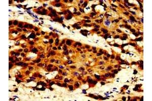Immunohistochemistry of paraffin-embedded human cervical cancer using ABIN7150346 at dilution of 1:100 (TOP2B anticorps  (AA 1400-1626))