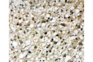Anti-Selenium Binding Protein 1 antibody, IHC(P) IHC(P): Human Liver Cancer Tissue