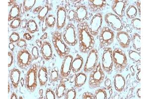 ABIN6383807 to Calnexin was successfully used to stain epithelial cells perinuclear in human renal carcinoma sections. (Calnexin anticorps  (Lumenal Region))