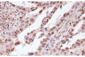 Immunohistochemistry of paraffin-embedded Human lung cancer using Phospho-ATF2(T71) Polyclonal Antibody at dilution of 1:100 (40x lens). (ATF2 anticorps  (pThr71))