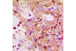 Immunohistochemical analysis of RPS13 staining in human breast cancer formalin fixed paraffin embedded tissue section. (RPS13 anticorps)