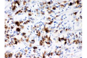 Anti- Mucin-5AC Picoband antibody, IHC(P) IHC(P): Human Gastric Cancer Tissue (MUC5AC anticorps  (AA 4848-5030))