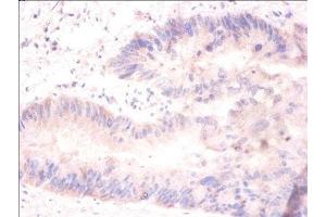 Immunohistochemistry of paraffin-embedded human colon cancer using ABIN7155377 at dilution of 1:100 (H2AFJ anticorps  (AA 2-129))